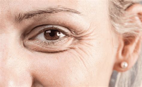 Is Eyelid Surgery Worth It The Benefits Of Eyelid Surgery Dr Amir Sadri