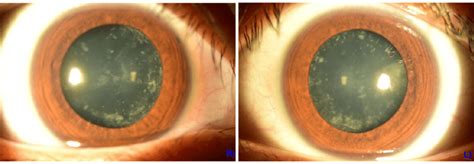 Anterior Segment Photography At The First Visit It Shows Cortical Download Scientific Diagram