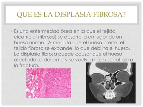 Displasia fibrosa