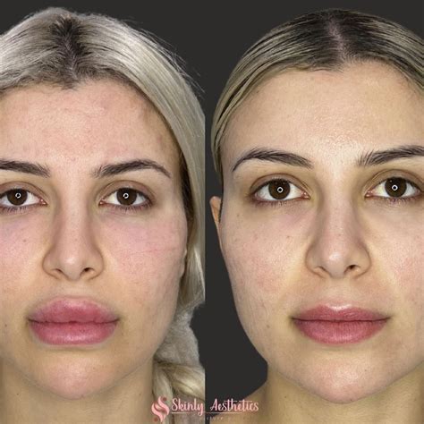 Dissolving Dermal Fillers With Hyaluronidase All You Need To Know