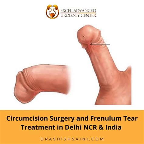 Circumcision And Frenulum Tear Treatment In Delhi By Dr Ashish Saini