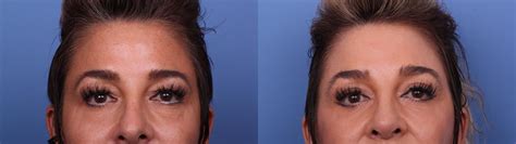 Blepharoplasty Before And After Pictures Case 568 Scottsdale