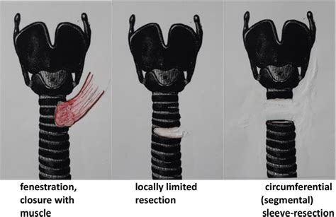 Resections on the trachea. | Download Scientific Diagram