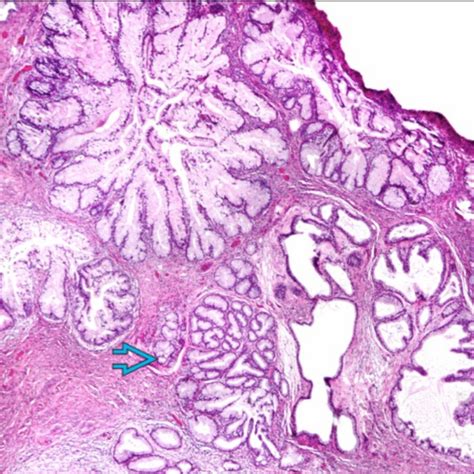 Minimal Deviation Adenocarcinoma Adenoma Malignum Telegraph