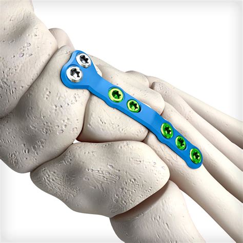 middle column fusion plates unite foot  ankle