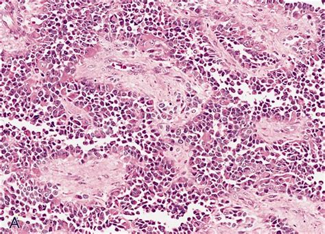 Pathology Outlines Alveolar Rhabdomyosarcoma