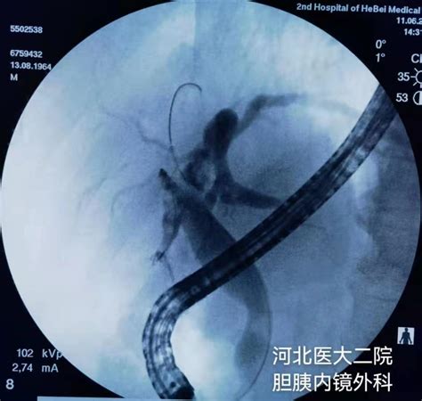 肝内胆管结石的ercp下治疗胆胰内镜网