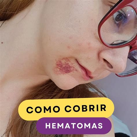Como Cobrir Hematoma E Hemangioma Usando Maquiagem Tutorial
