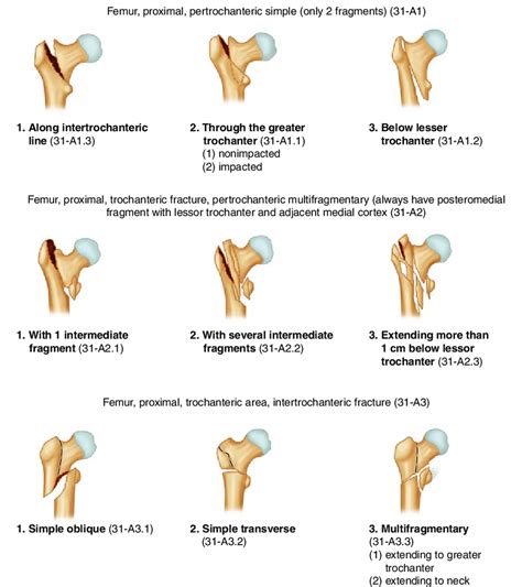 Ao Ota Fracture Classification Of Proximal Femur Trochanteric Region | The Best Porn Website