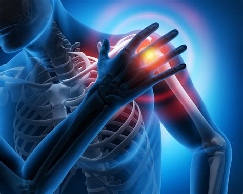 Calcific Tendonitis - Shoulder Pain Relief