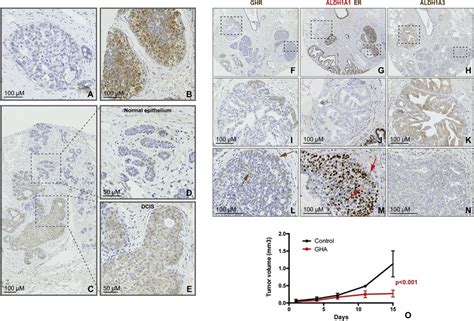 GHR Defines A Cell Population That Is Expanded In DCIS A And B