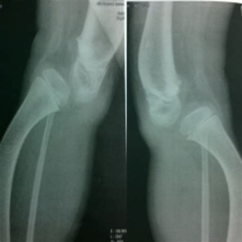 ((a), (b), and (c)) Image of a greater trochanteric fracture including... | Download Scientific ...