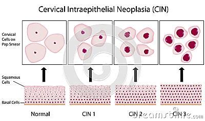 Cervical Dysplasia Stock Photos - Image: 22445763