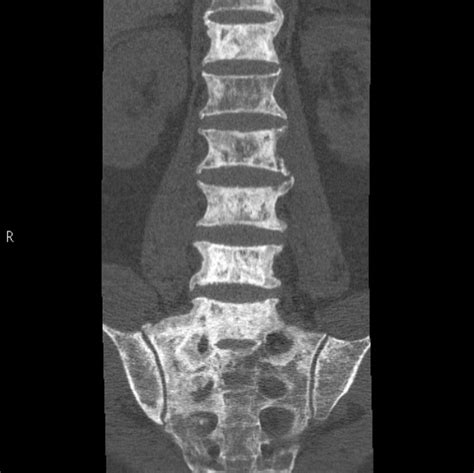 Lumbar Lytic And Sclerotic Bone Metastases Image Radiopaedia Org