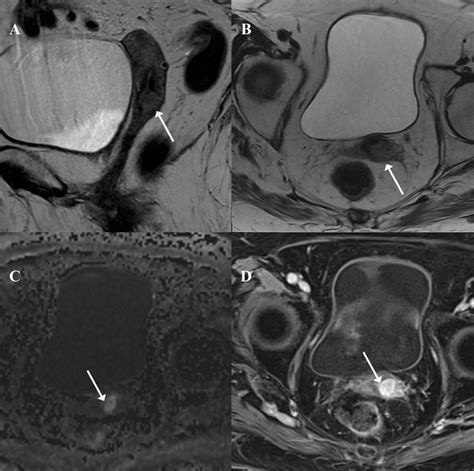 Pelvic Magnetic Resonance Imaging Mri An Infiltrative Cervical Mass