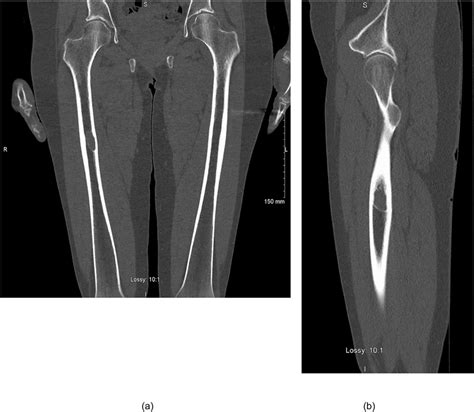 (a,b) Coronal and Saggital sections from CT Skeletal survey for ...