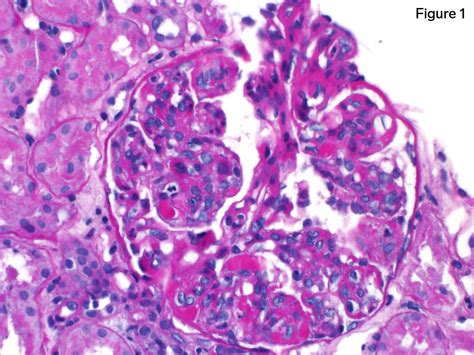 Cryoglobulinemic Glomerulonephritis Teaching Points Arkana Labs