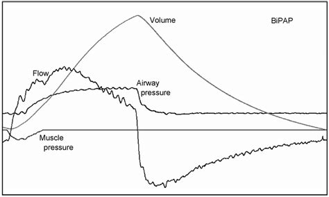 Characteristic Waveforms With Bi Level Positive Airway Pressure