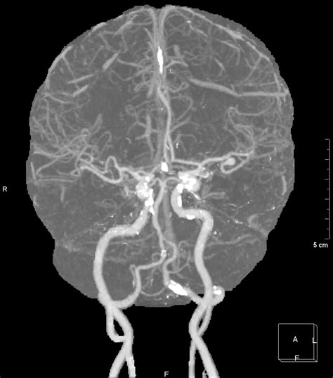 Vascular Anatomy Of The Brain Review Nowyouknow Neuro