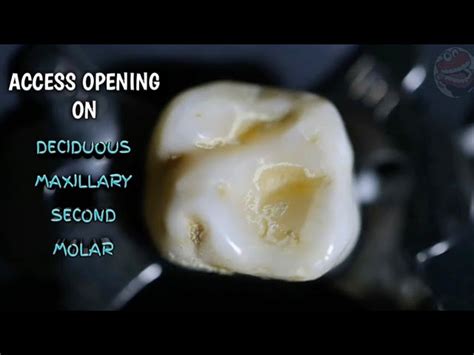 Primary Maxillary Second Molar