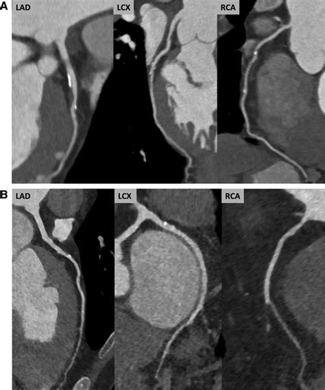 Noninvasive Imaging Of Atherosclerotic Plaque Progression Circulation Cardiovascular Imaging