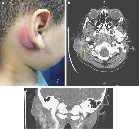 Branchial cleft cyst causes, types, signs, symptoms, diagnosis & treatment