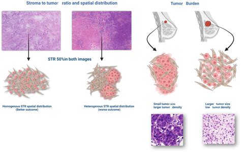 Illustrated Diagram Showing The Difference Between Stroma To Tumor