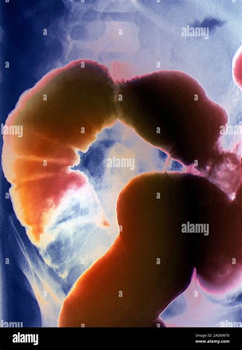 Intussusception Of The Intestines Coloured Barium X Ray Of A Section