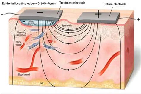 How Electricity Heals Wounds Three Times Faster Qs Study