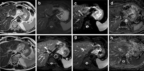 Axial T2 With A And Without B Fat Suppression Showing A Lesion Of