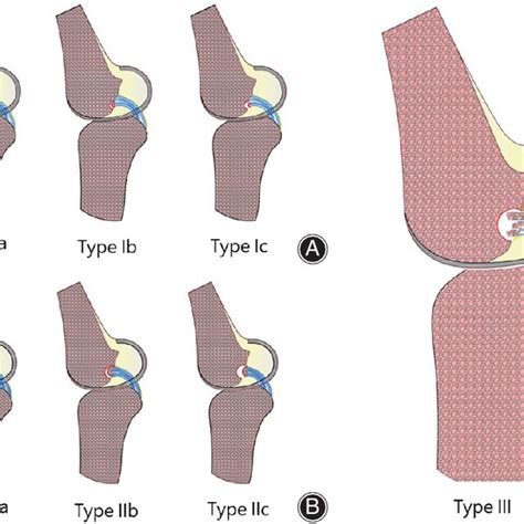 Xiangya Classification Of The Pcl Femoral Avulsion Fracture Type I