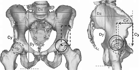 Antero Posterior Left And Lateral Right Views Of A Pelvic 3d Ct Download Scientific