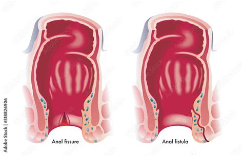 Medical Illustration Shows Two Common Anal Disorders An