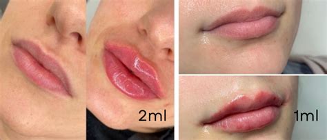 1ml Vs 2ml Lip Filler How To Choose The Right Fillers