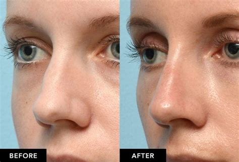 Surgical Vs Non Surgical Nose Job Nose Filler In San Francisco