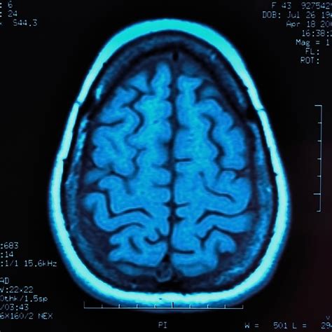 Urinary Retention in Multiple Sclerosis - Multiple Sclerosis News Today