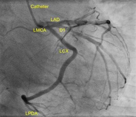 Dominant left coronary artery – All About Cardiovascular System and ...