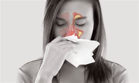 Decolgen Sinusitis Causes Symptoms Treatment Unilab