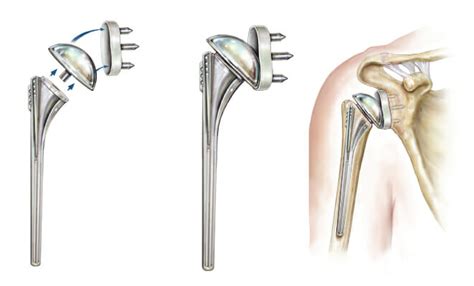 Total Shoulder Replacement Surgery Summit Orthopedics