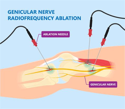 Genicular Nerve Block for Chronic Knee Pain | Barr Center