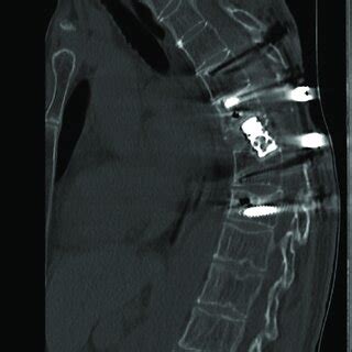 Sagittal Computed Tomography Ct Of The Spine Showing The