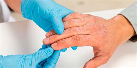 Dermatitis en manos qué es causas y tratamiento Caser