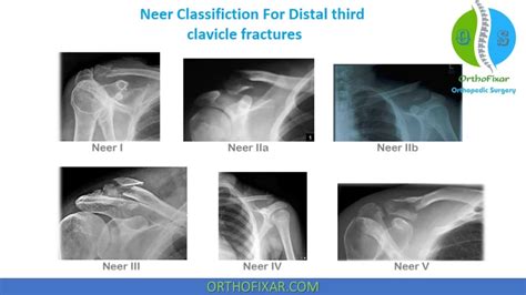 Clavicle Fractures OrthoFixar 2025