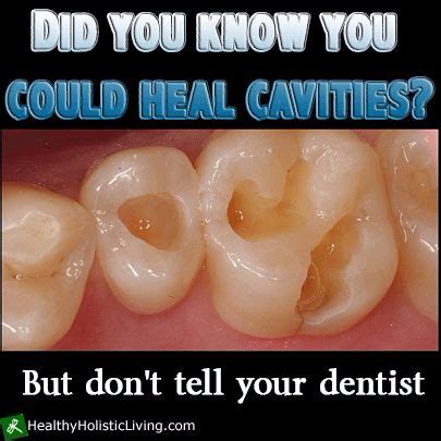 How to Heal Cavities Naturally - Creative Ideas