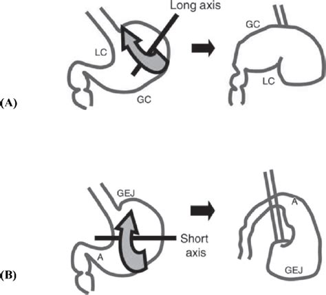 A Organo Axial Volvulus Diagram Shows The Rotation Of The Stomach Download Scientific