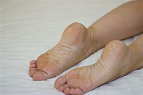 Dry Skin of the Feet. Foot Treatment. Stock Image - Image of white, hand: 82836635