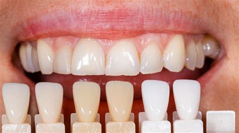 The Veneer Process What To Expect Padmaja Yalamanchili Dds Pc