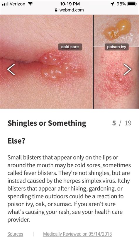 Treat Shingles Naturally At Home Artofit