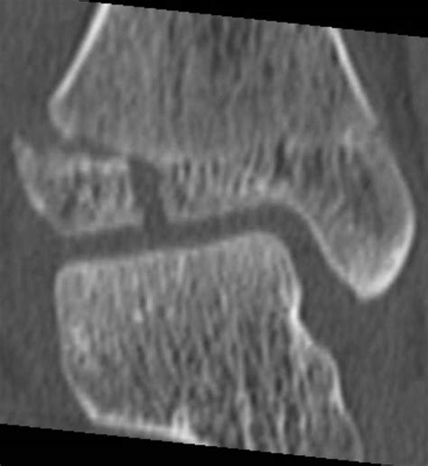 Tillaux Fracture Radrounds Radiology Network