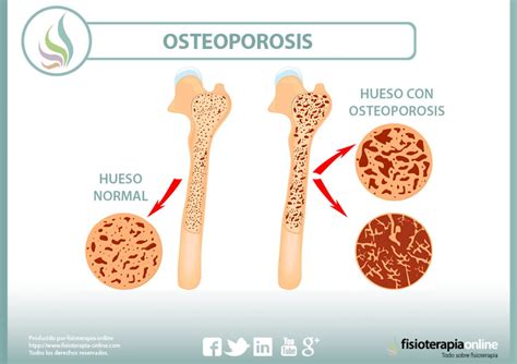 Osteoporosis Qué Es Causas Síntomas Tratamiento Y Consejos Fisioonline